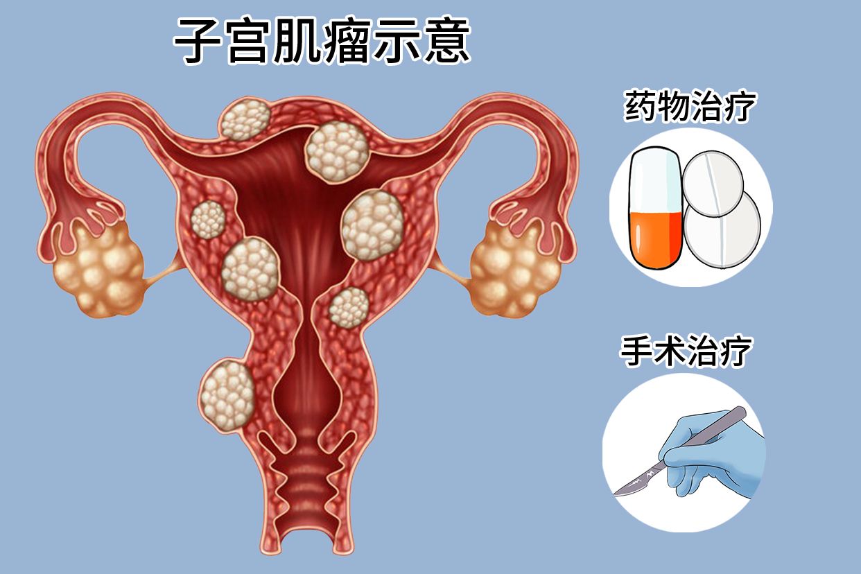 子宫肌瘤最新最有效的治疗方法介绍